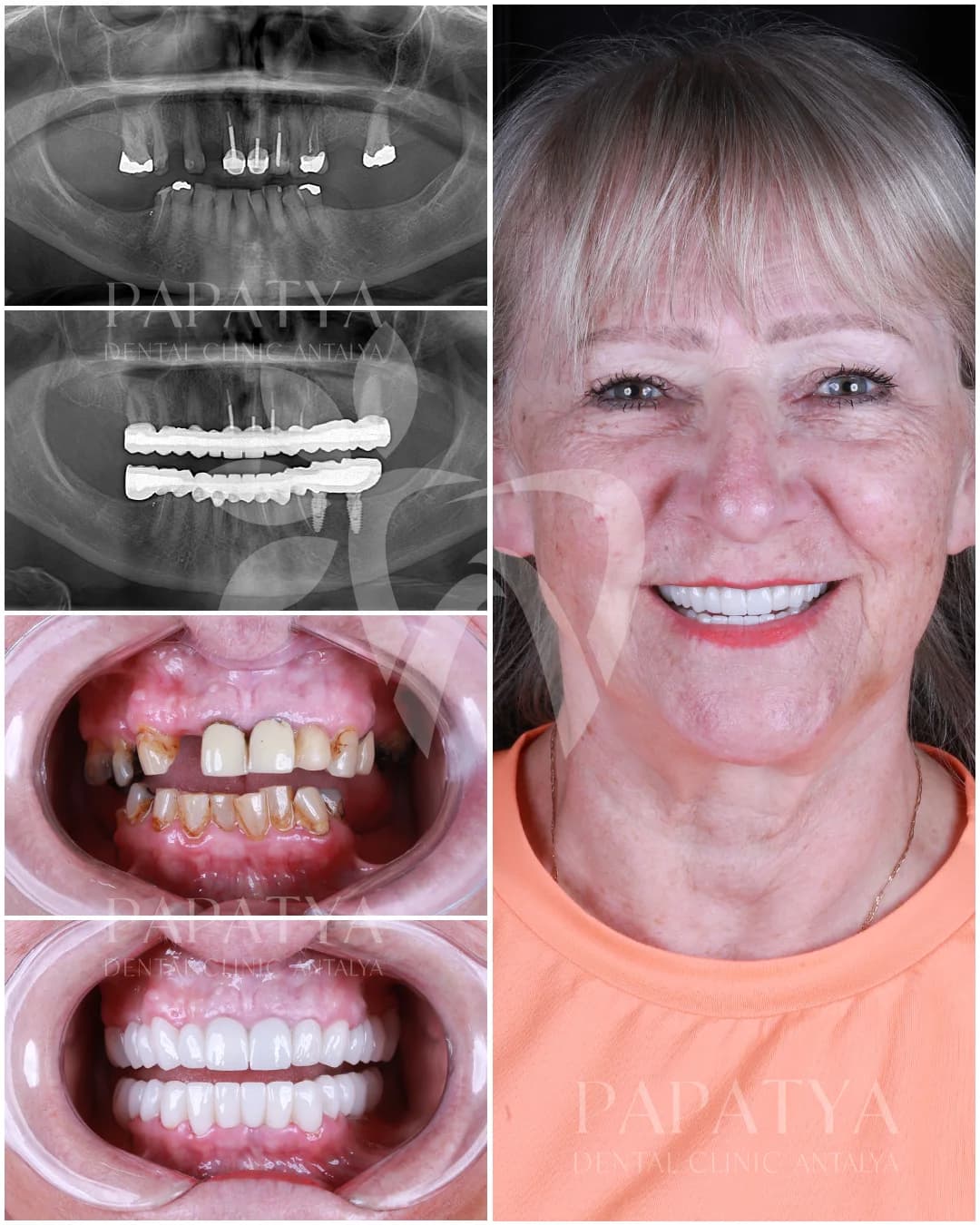 Zirconia Crown before and after result