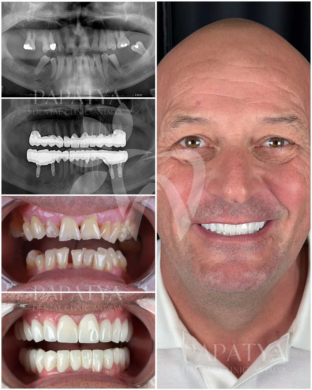 Dental Implant before and after result