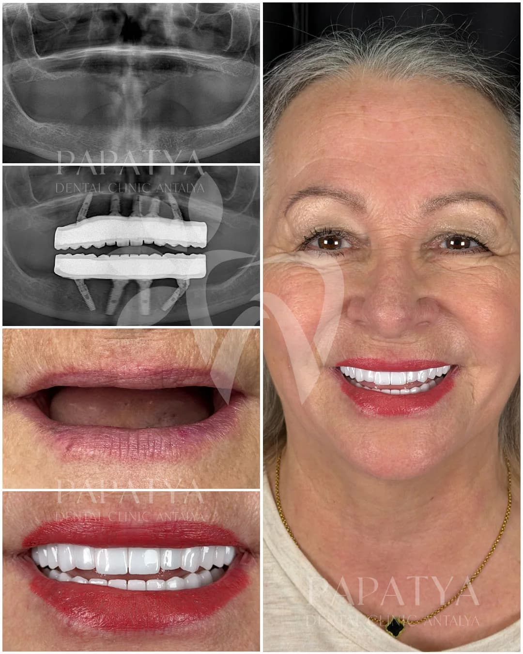 All on 4 Implant before and after result
