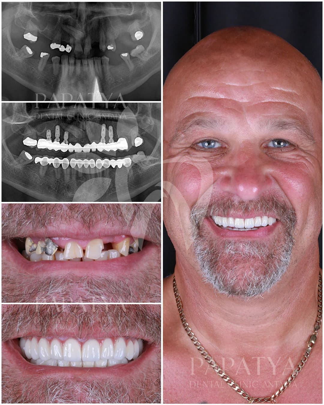 Dental Implant before and after result